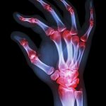 Actualización sobre el manejo de la Artritis Reumatoide