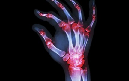 Actualización sobre el manejo de la Artritis Reumatoide