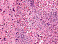 Actualización en Lupus Eritematoso Sistémico (LES) : El papel de la farmacia hospitalaria
