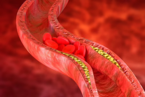 Atherosclerosis is an accumulation of cholesterol plaques in the
