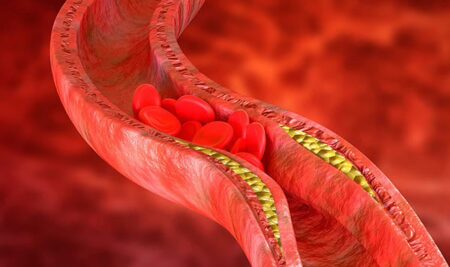 La fluvastatina se consolida como alternativa en pacientes con intolerancia muscular a estatinas